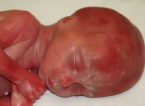 Most babies come out of abortion as torn and bloody parts of this precious whole.