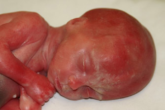 abortion survivor