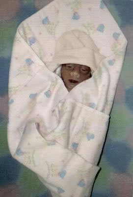 Hope Marie, a beautiful little girl with anencephaly.