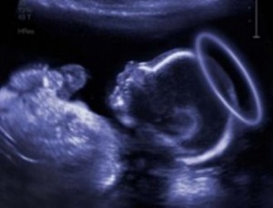 Fetus with Halo