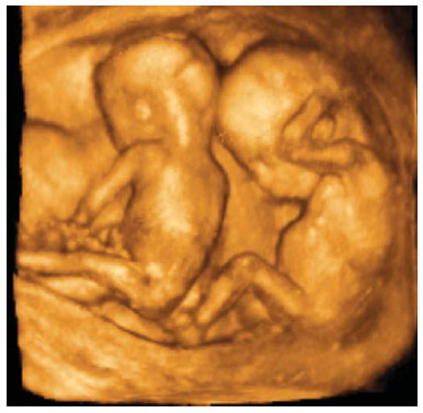 twins, Planned Parenthood
