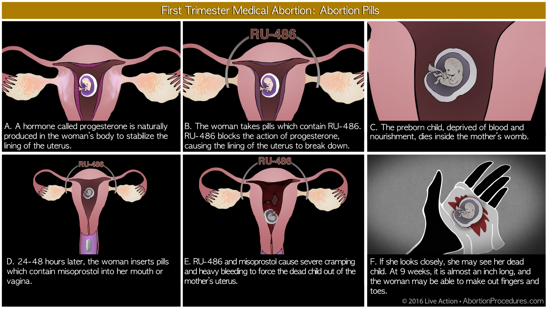 These are the 4 most prevalent abortion procedures in America