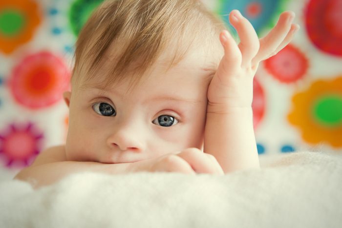 down-syndrome-3