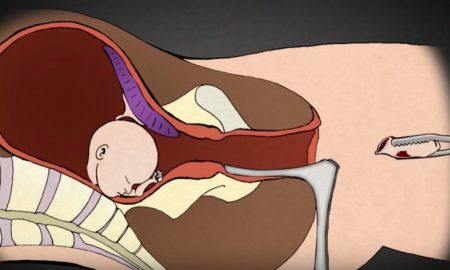 D&E abortion pulls baby apart piece by piece, Go to www.AbortionProcedures.com for facts on abortion