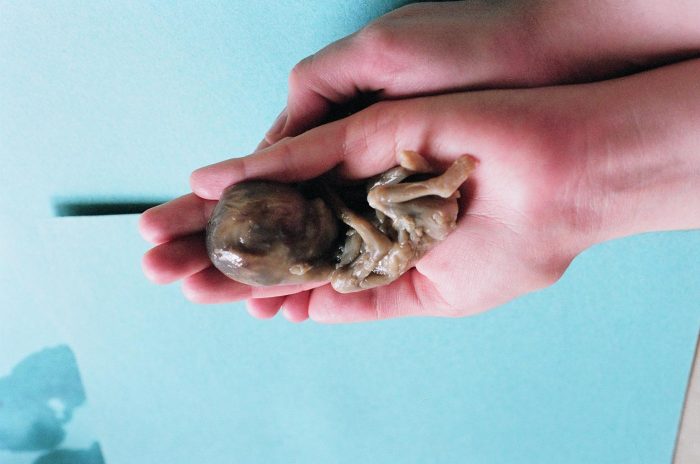 abortion This 21-week old preborn child was killed through a prostaglandin abortion.