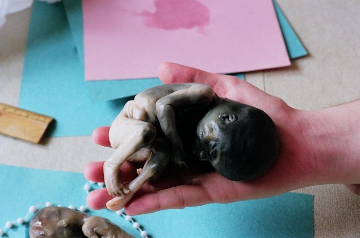 abortion This 24-week old preborn child died due to a prostaglandin abortion.