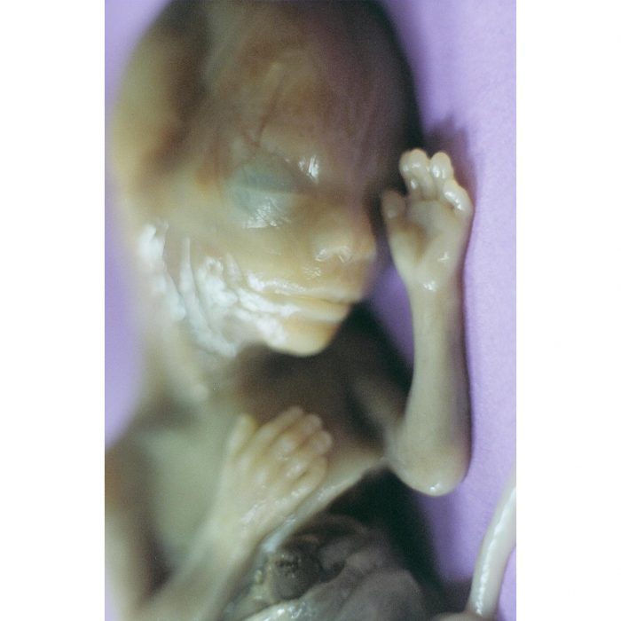 abortion This preborn child was aborted at 21 weeks gestation through a Prostaglandin abortion.