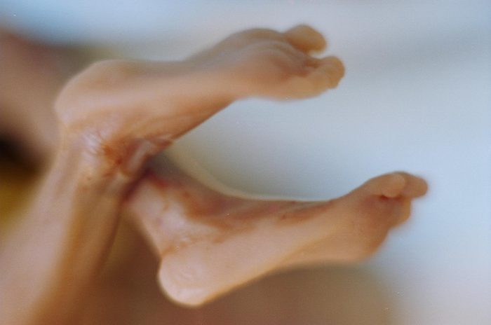 abortion The tiny feet of a 21-week old preborn child killed by a prostaglandin abortion.
