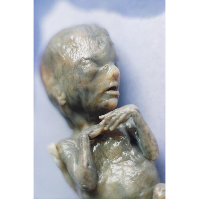 abortion This child was aborted at 18 weeks gestation using the saline abortion method - note the burned skin.