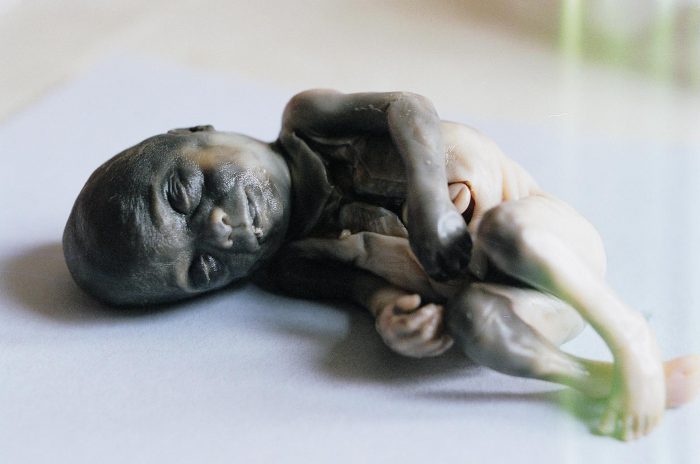 abortion A late-term baby who was killed by abortion.