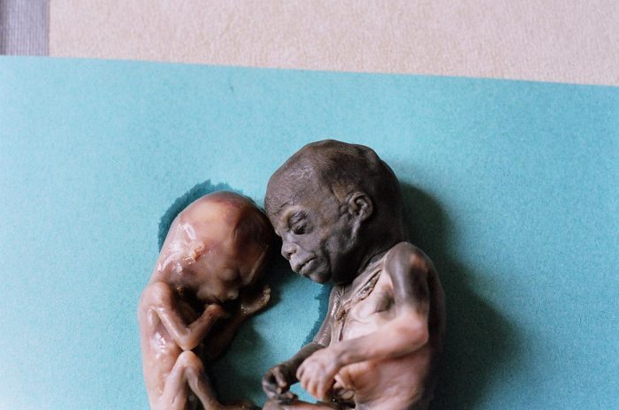 abortion Two children who died, one after the other, from abortion.
