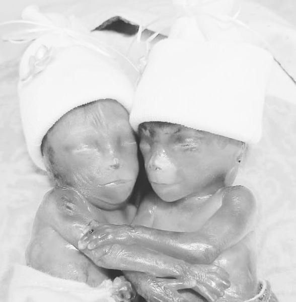 Amanda Powell's premature identical twins Walker and Clark born too soon to survive outside the womb.