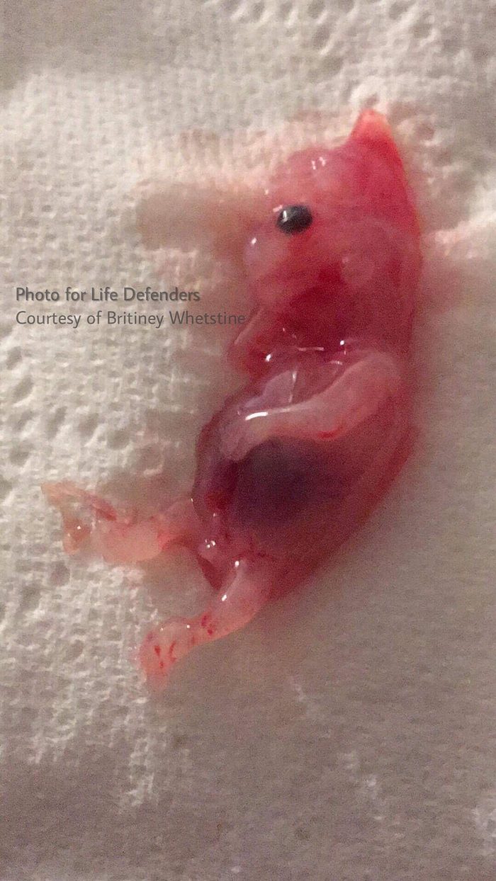 miscarriage