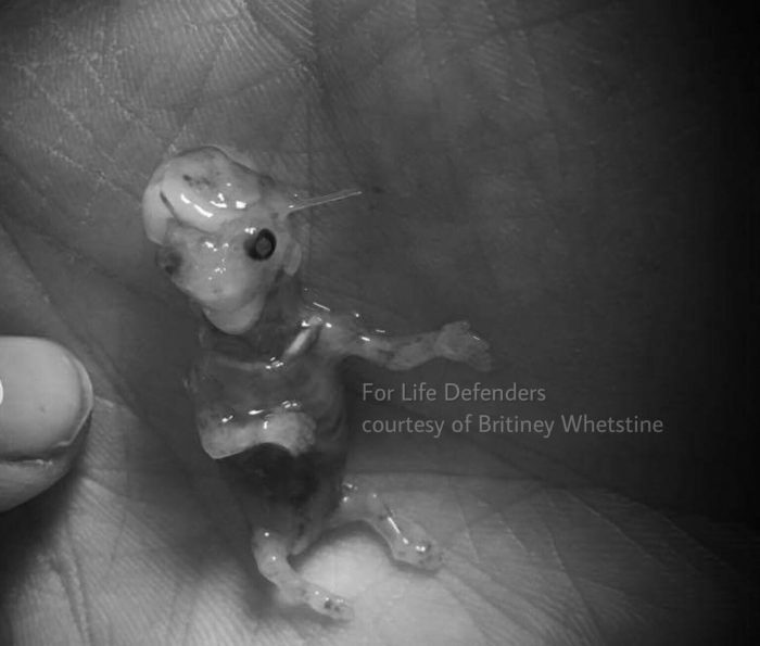miscarriage