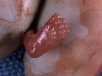 Abortion at 8 weeks (Image credit: AbortionNo.org)