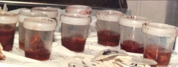 Image: Aborted babies after suction abortion