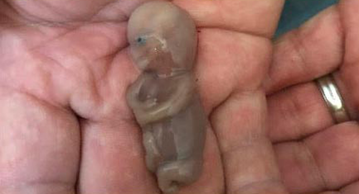 miscarried, miscarriage