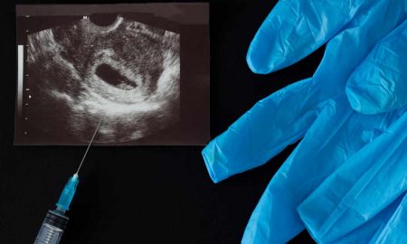 abortion
