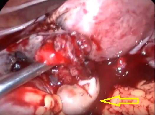 Image: Preborn baby ectopic pregnancy 10 weeks gestation