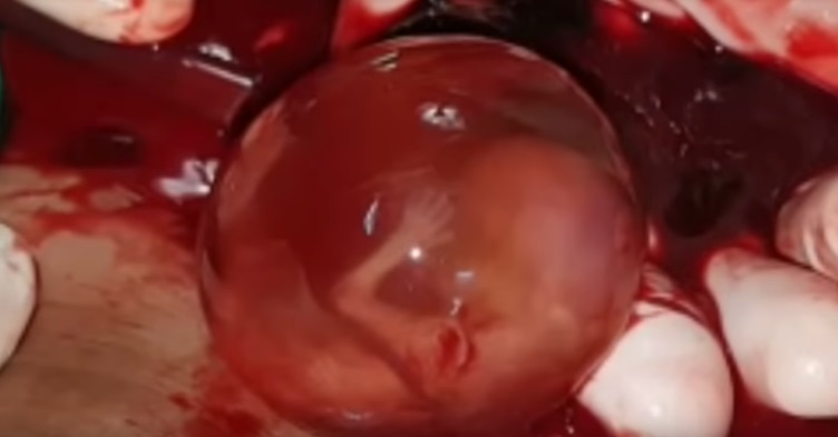Image: Preborn baby ectopic pregnancy 11 weeks gestation