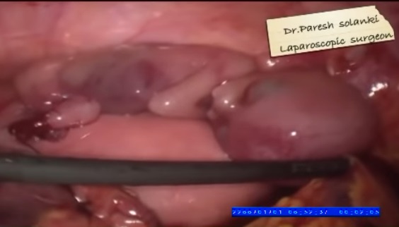 Image: Preborn baby ectopic pregnancy 14 weeks gestation