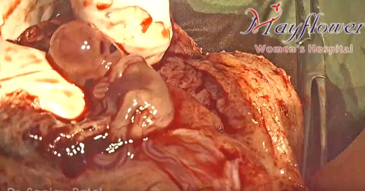 Image:Preborn baby ectopic pregnancy 9 weeks gestation