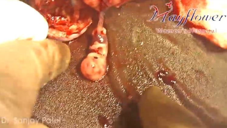 Image: Preborn baby ectopic pregnancy 9 weeks gestation