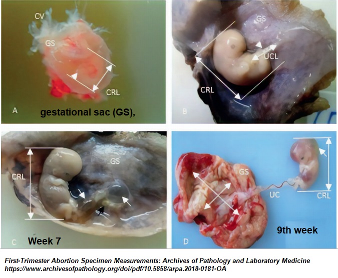 Image: First trimester embryo pathology (Image credit: Arch Pathol Lab Med)