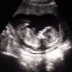 pro-life, Georgia heartbeat, abortion restrictions