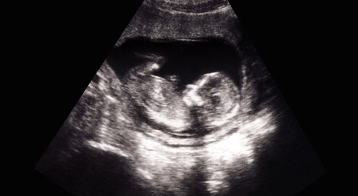 pro-life, Georgia heartbeat, abortion restrictions