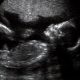 ultrasound, viability, abortion, Russia