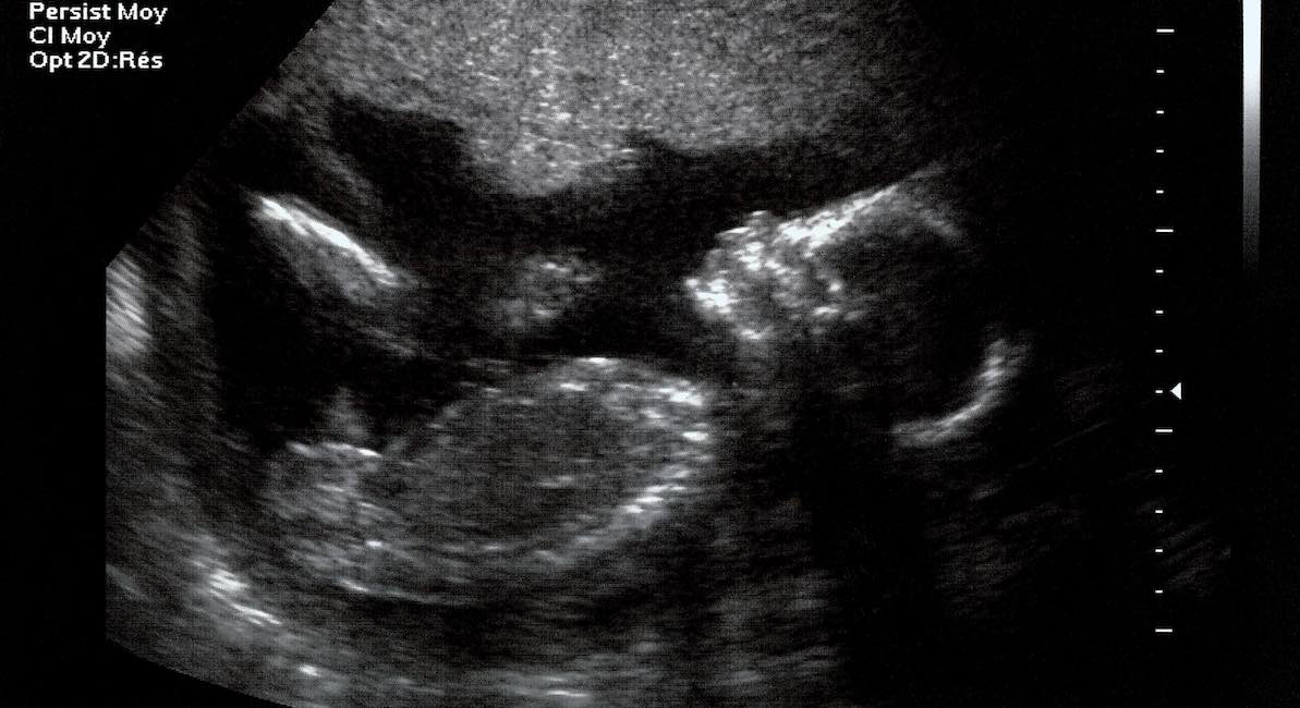 ultrasound, viability, abortion, Russia