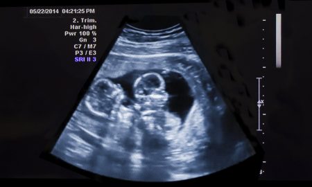 twins, abortion pill, abortion, twin