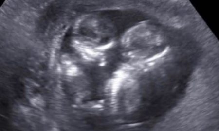abortion