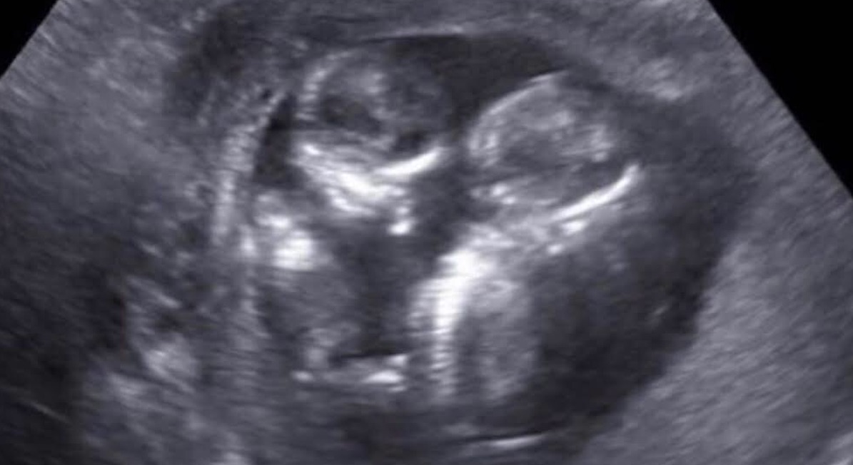 abortion
