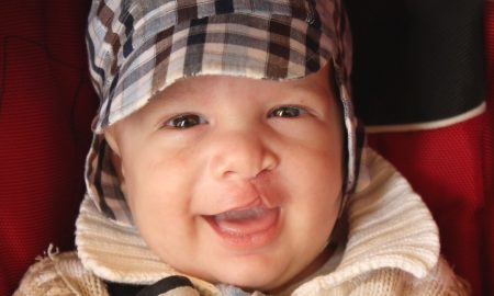 cleft lip