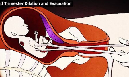 D&E abortion