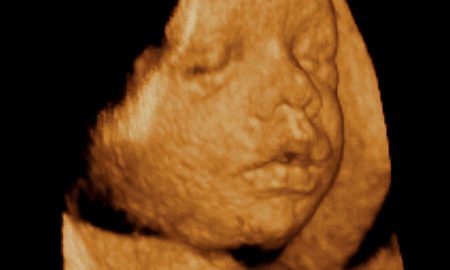 abortion